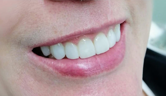 BLANQUEAMIENTO DENTAL