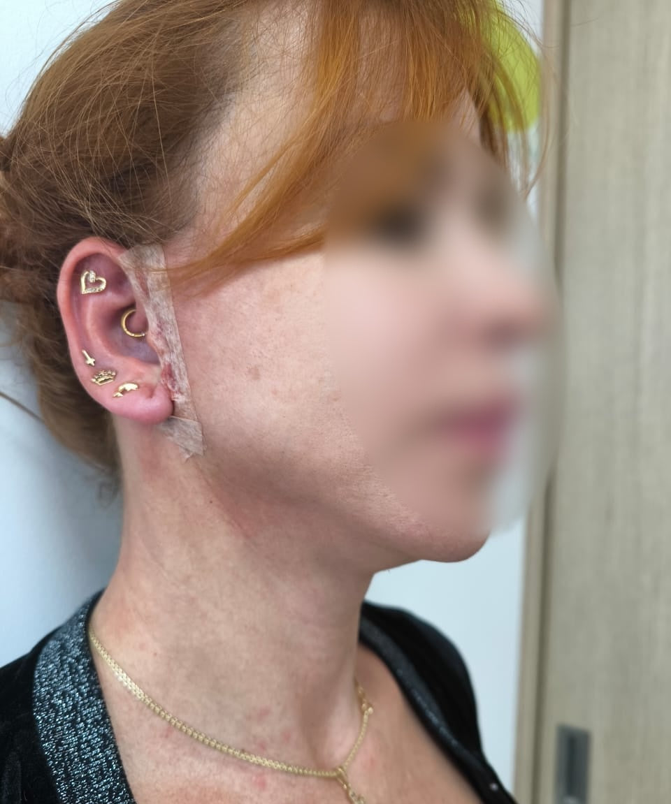 LIFTING FACIAL