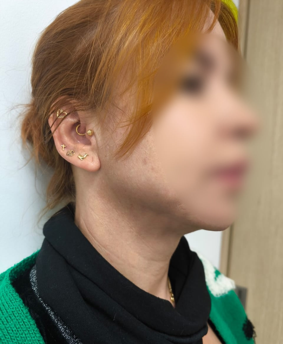 LIFTING FACIAL