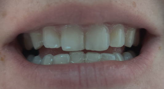 MICRO DISEÑO DE SONRISA