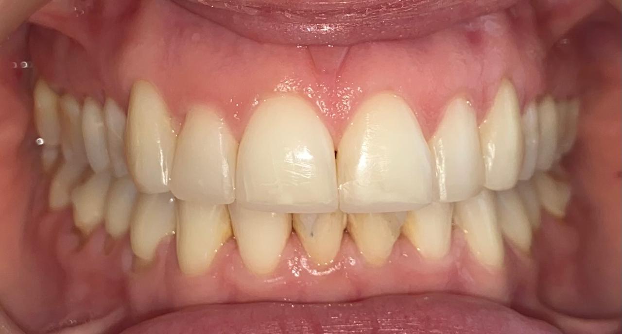 ORTODONCIA INVISIBLE