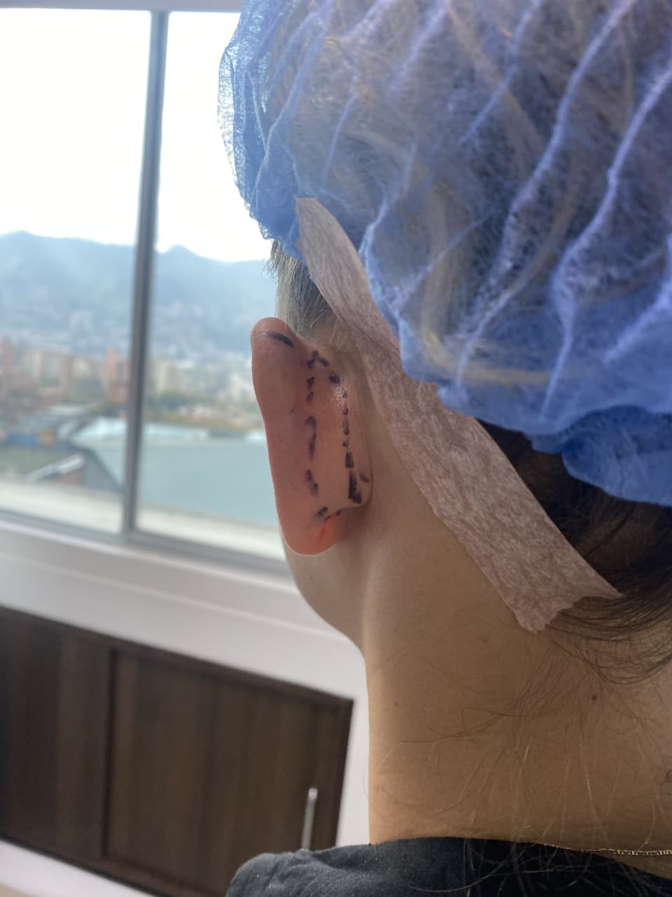 OTOPLASTÍA