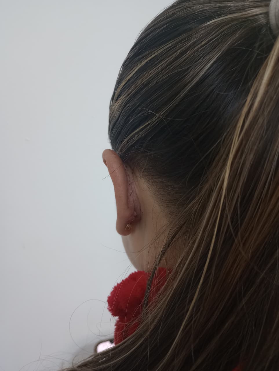 OTOPLASTÍA