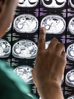 TRATAMIENTO DE ACCIDENTE CEREBROVASCULAR