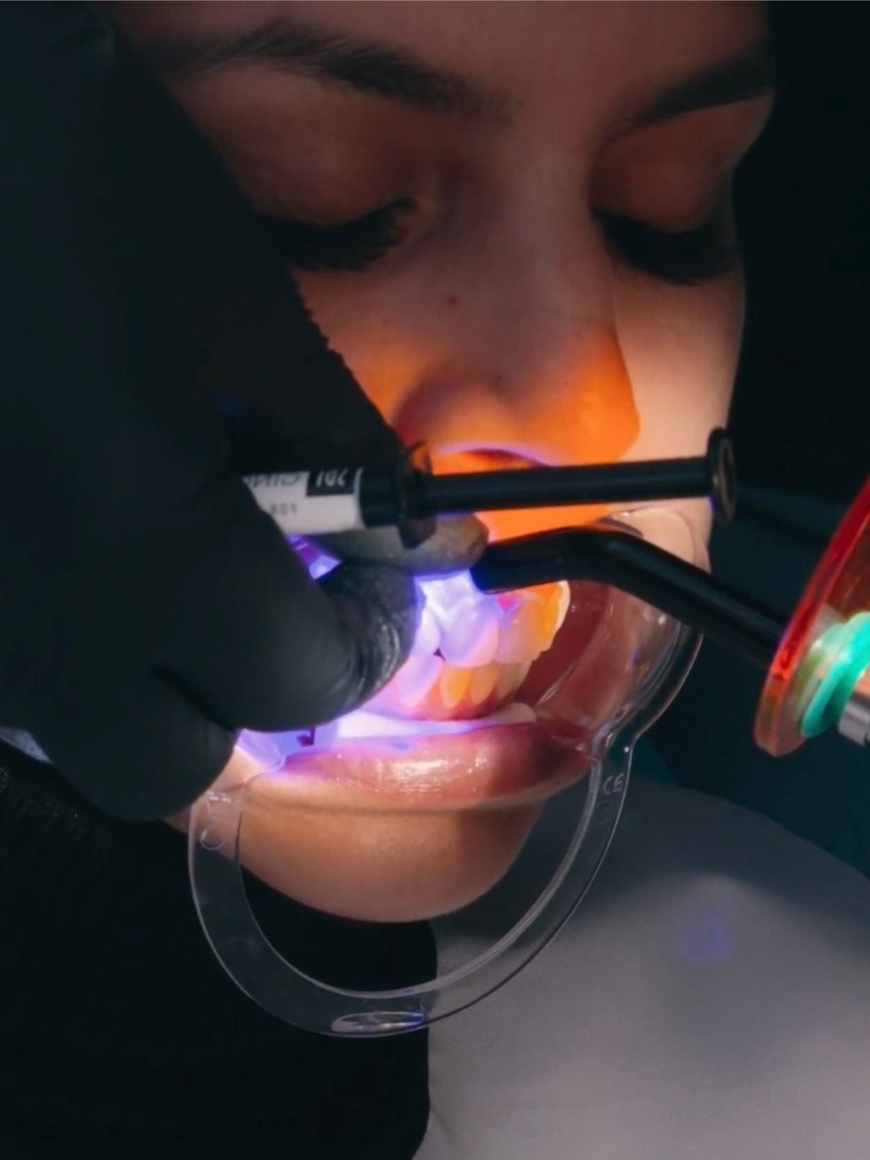 BLANQUEAMIENTO DENTAL