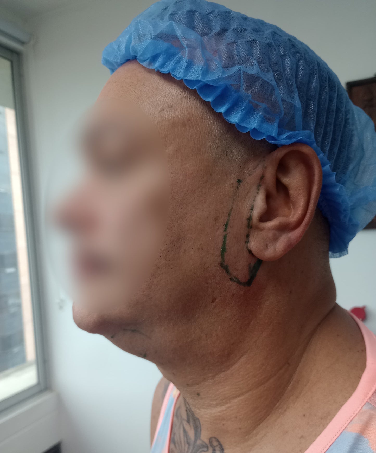 LIFTING FACIAL