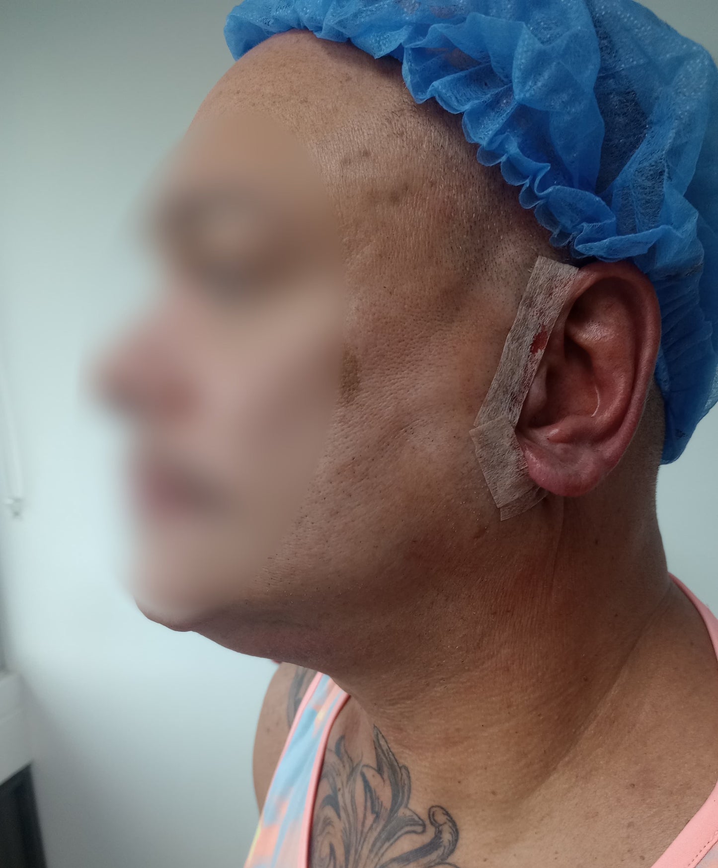 LIFTING FACIAL