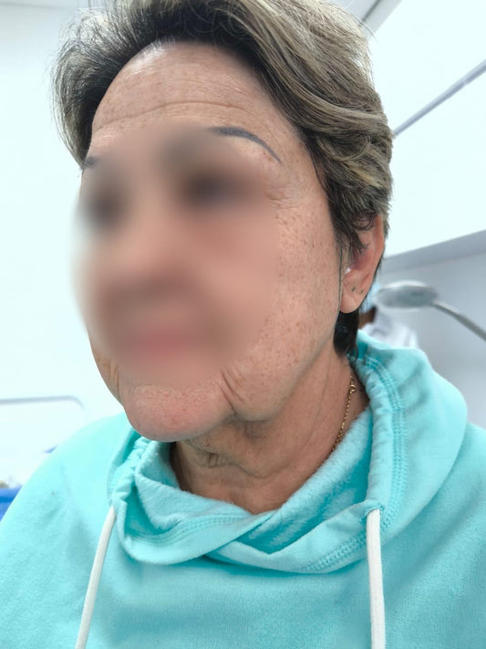 LIFTING FACIAL