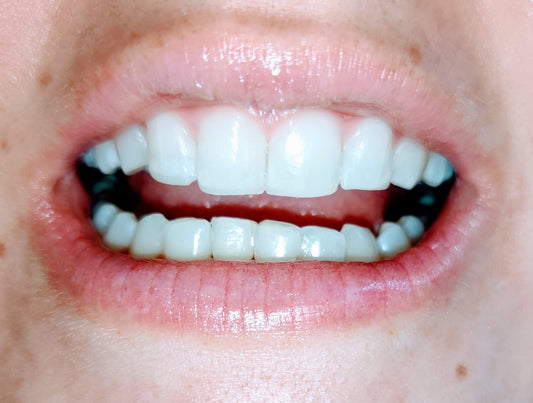 MICRO DISEÑO DE SONRISA