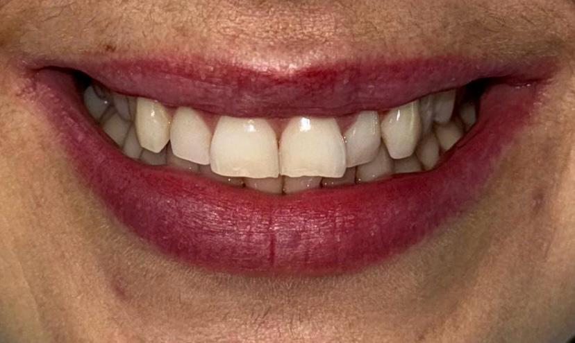 ORTODONCIA INVISIBLE