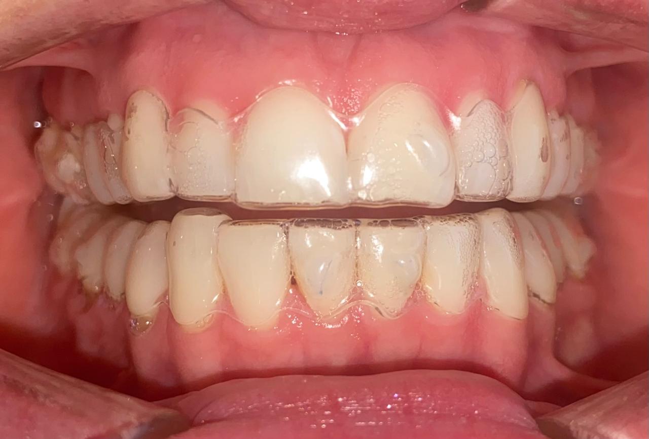 ORTODONCIA INVISIBLE