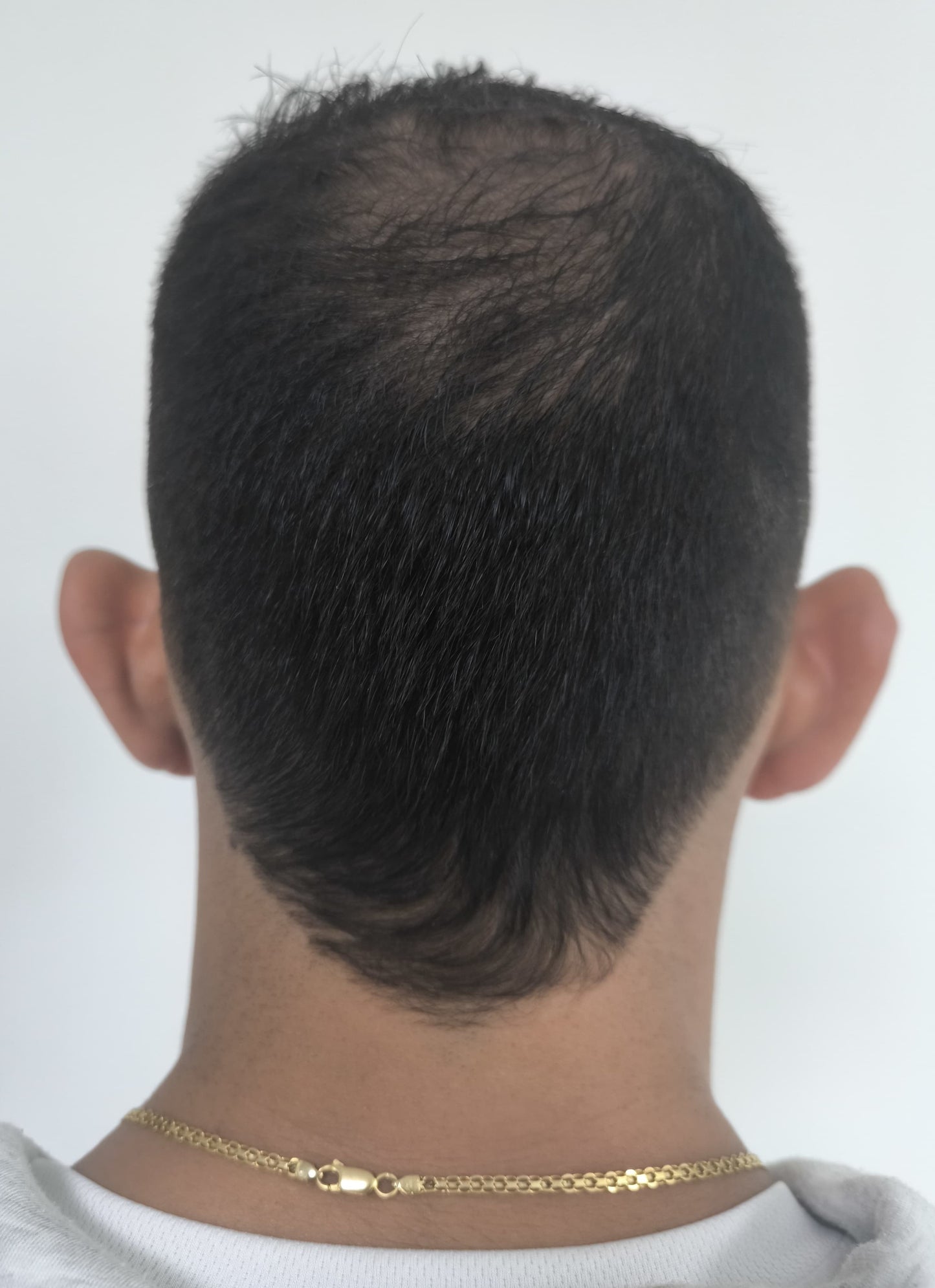 OTOPLASTÍA