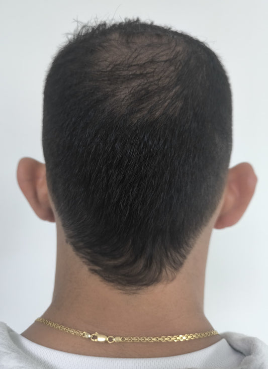 OTOPLASTÍA