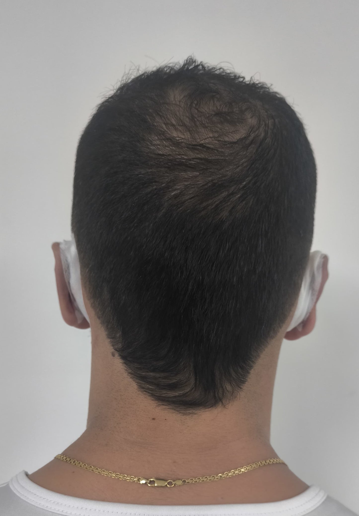 OTOPLASTÍA