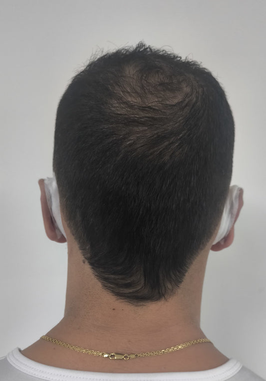 OTOPLASTÍA