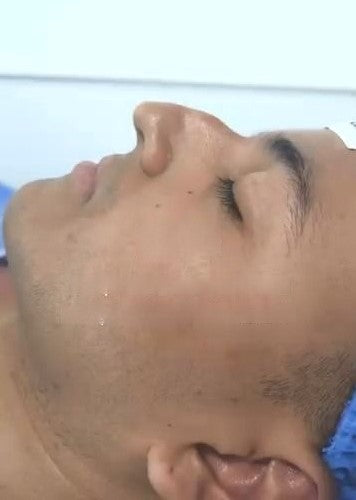 RINOPLASTÍA