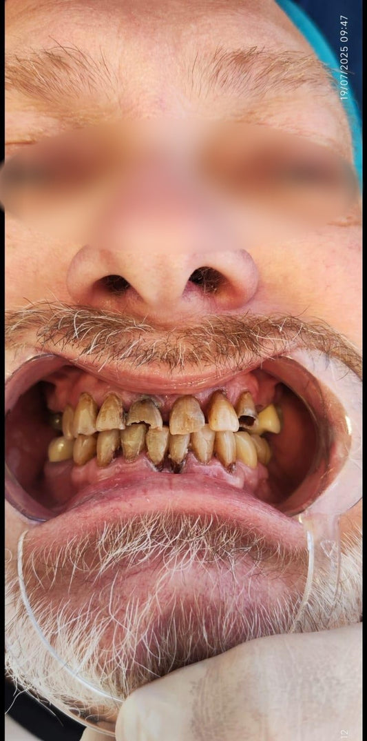 DISEÑO DE SONRISA